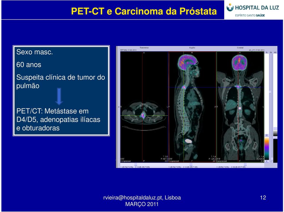 pulmão PET/CT: Metástase em D4/D5,