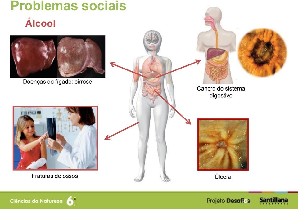 Cancro do sistema