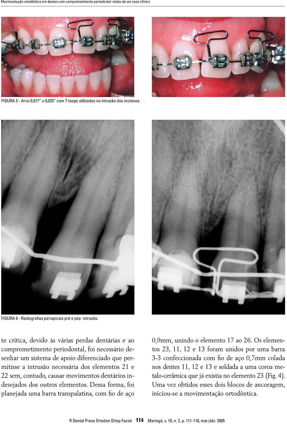 te crítica, devido às várias perdas dentárias e ao comprometimento periodontal, foi necessário desenhar um sistema de apoio diferenciado que permitisse a intrusão necessária dos elementos 21 e 22