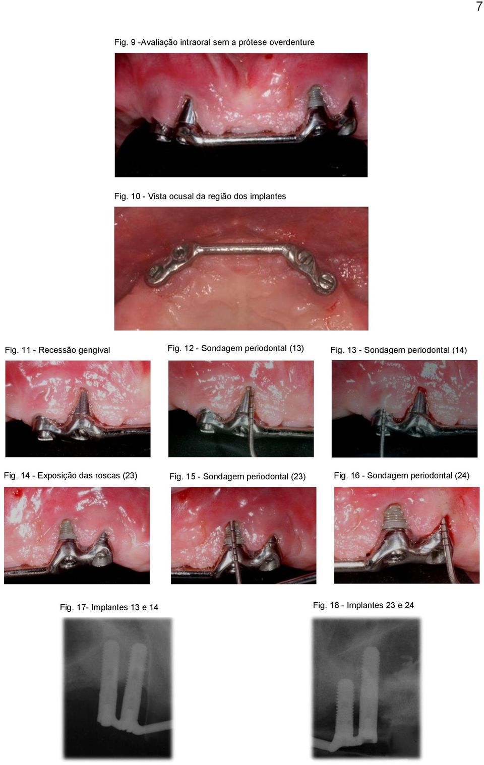 12 - Sondagem periodontal (13) Fig. 13 - Sondagem periodontal (14) Fig.