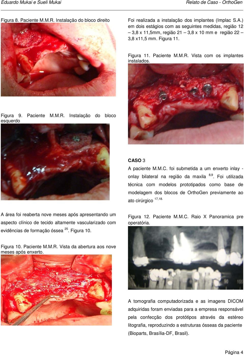 Paciente M.M.R. Instalação do bloco esquerdo CASO 3 A paciente M.M.C. foi submetida a um enxerto inlay - onlay bilateral na região da maxila 8,9.
