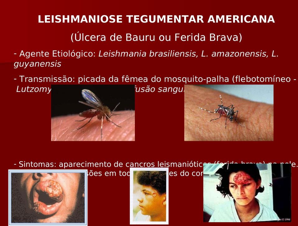 guyanensis - Transmissão: picada da fêmea do mosquito-palha (flebotomíneo Lutzomya longipalpis,