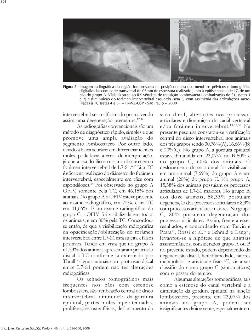 Visibilizou-se ao RX vértebra de transição lombossacra (lombarização de S1) (setas 1 e 2) e diminuição do forâmen intervertebral esquerdo (seta 3) com assimetria das articulações sacroilíacas à TC