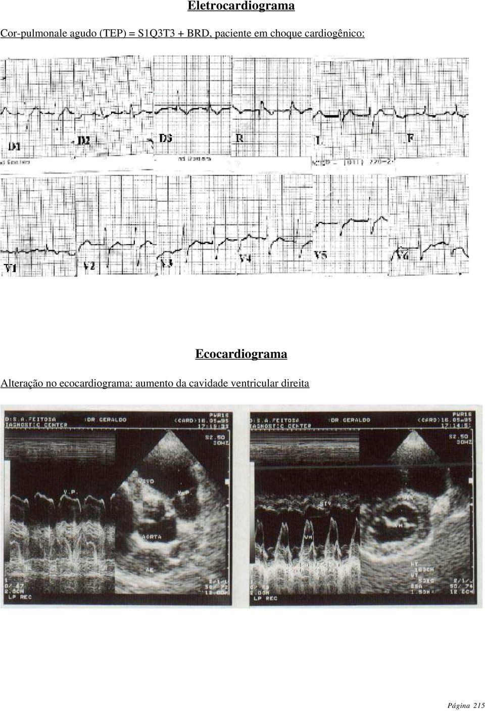 Ecocardiograma Alteração no ecocardiograma: