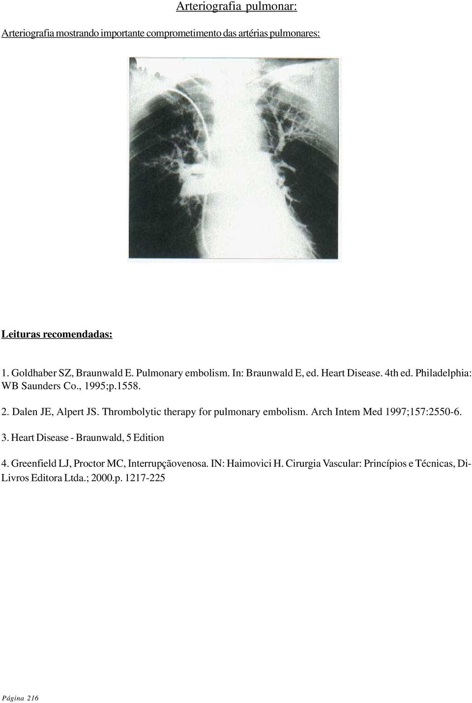 Dalen JE, Alpert JS. Thrombolytic therapy for pulmonary embolism. Arch Intem Med 1997;157:2550-6. 3. Heart Disease - Braunwald, 5 Edition 4.