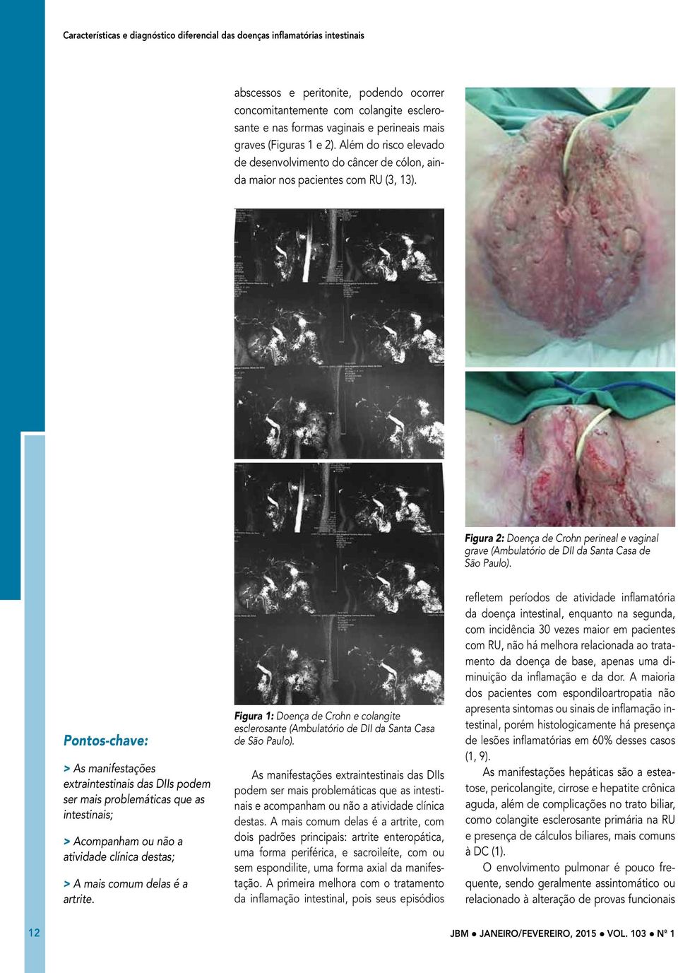 Figura 2: Doença de Crohn perineal e vaginal grave (Ambulatório de DII da Santa Casa de São Paulo).