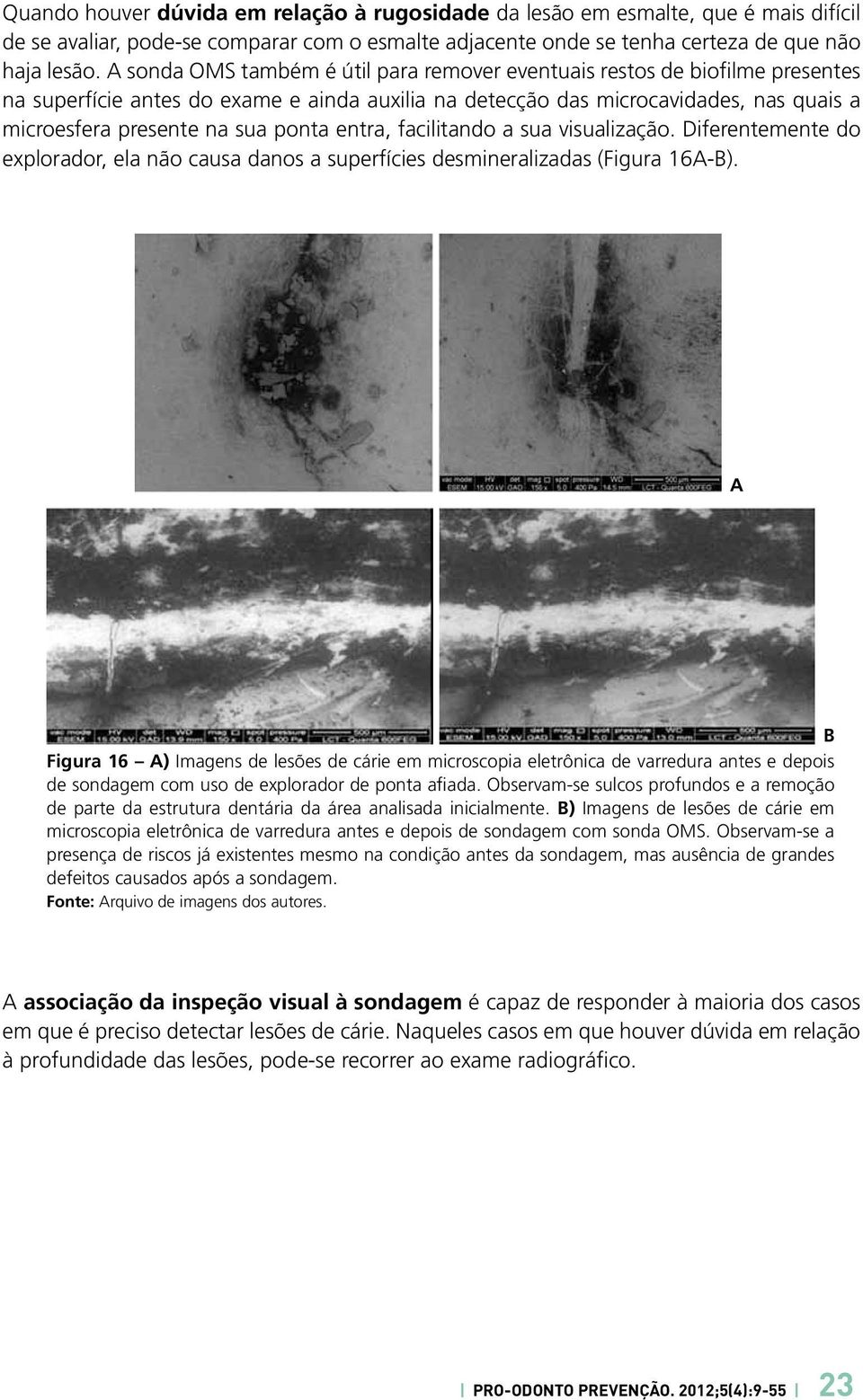 ponta entra, facilitando a sua visualização. Diferentemente do explorador, ela não causa danos a superfícies desmineralizadas (Figura 16A-B).