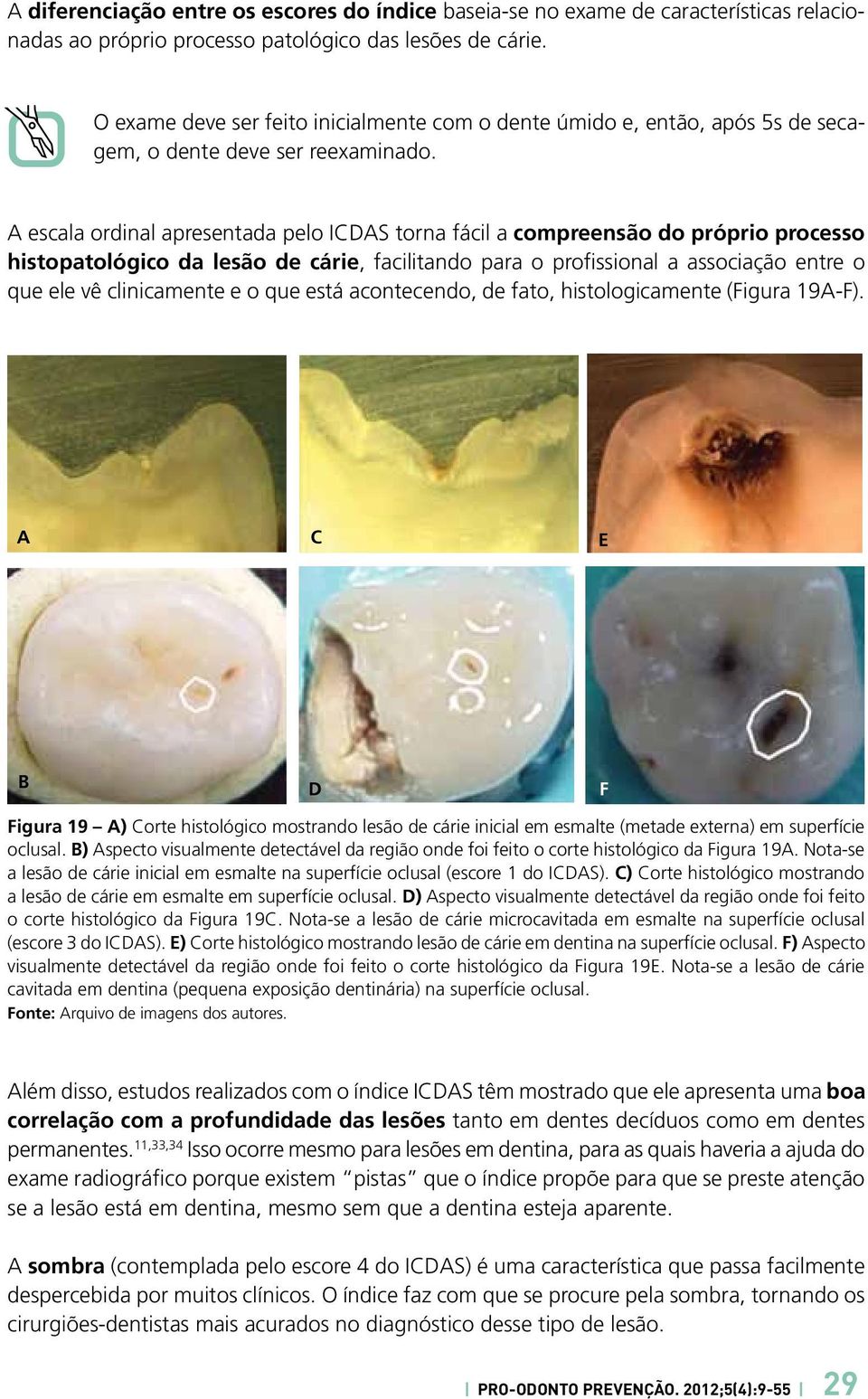 A escala ordinal apresentada pelo ICDAS torna fácil a compreensão do próprio processo histopatológico da lesão de cárie, facilitando para o profissional a associação entre o que ele vê clinicamente e