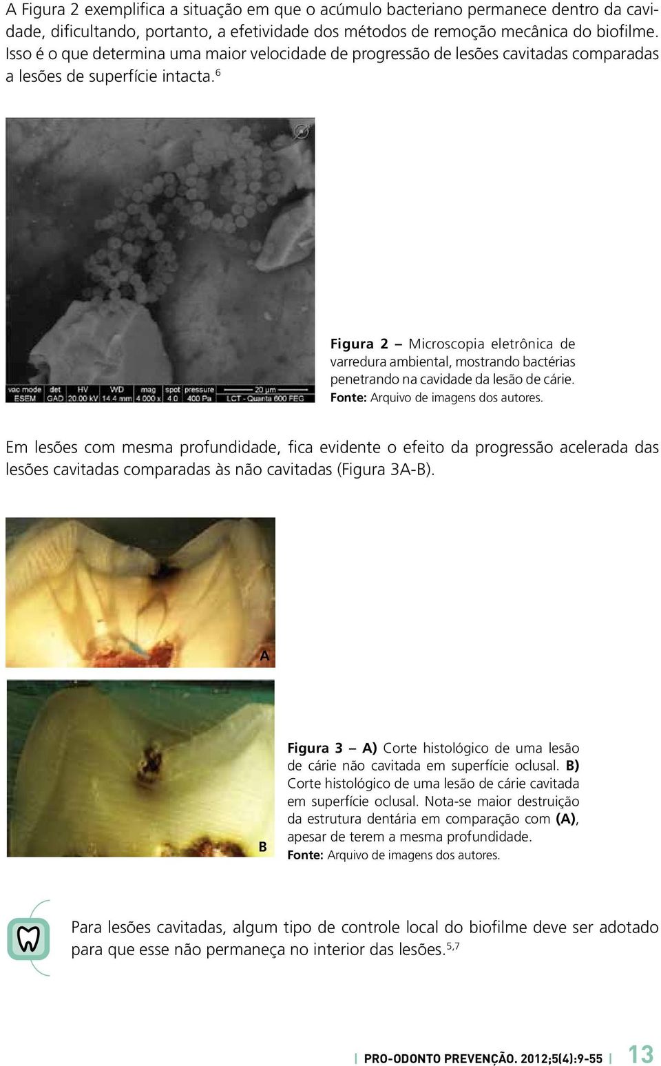 6 Figura 2 Microscopia eletrônica de varredura ambiental, mostrando bactérias penetrando na cavidade da lesão de cárie.