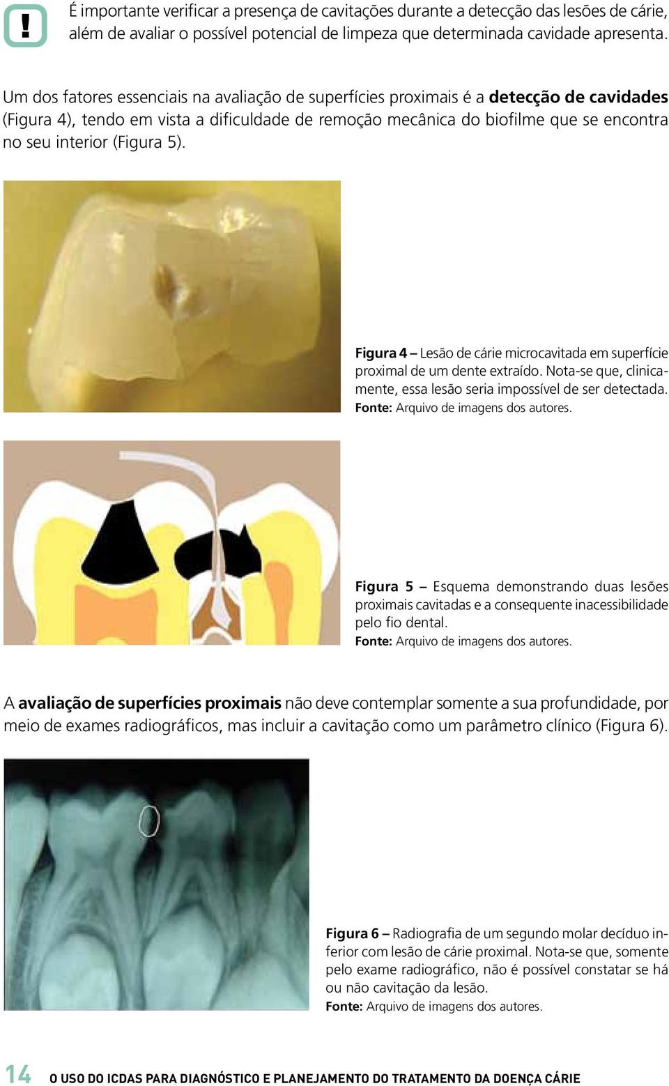 (Figura 5). Figura 4 Lesão de cárie microcavitada em superfície proximal de um dente extraído. Nota-se que, clinicamente, essa lesão seria impossível de ser detectada.