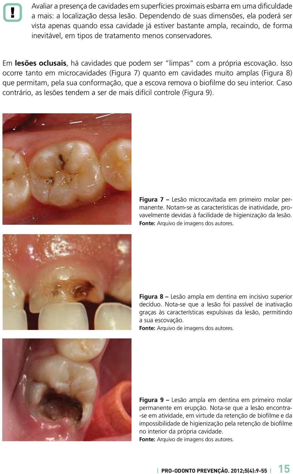 Em lesões oclusais, há cavidades que podem ser limpas com a própria escovação.