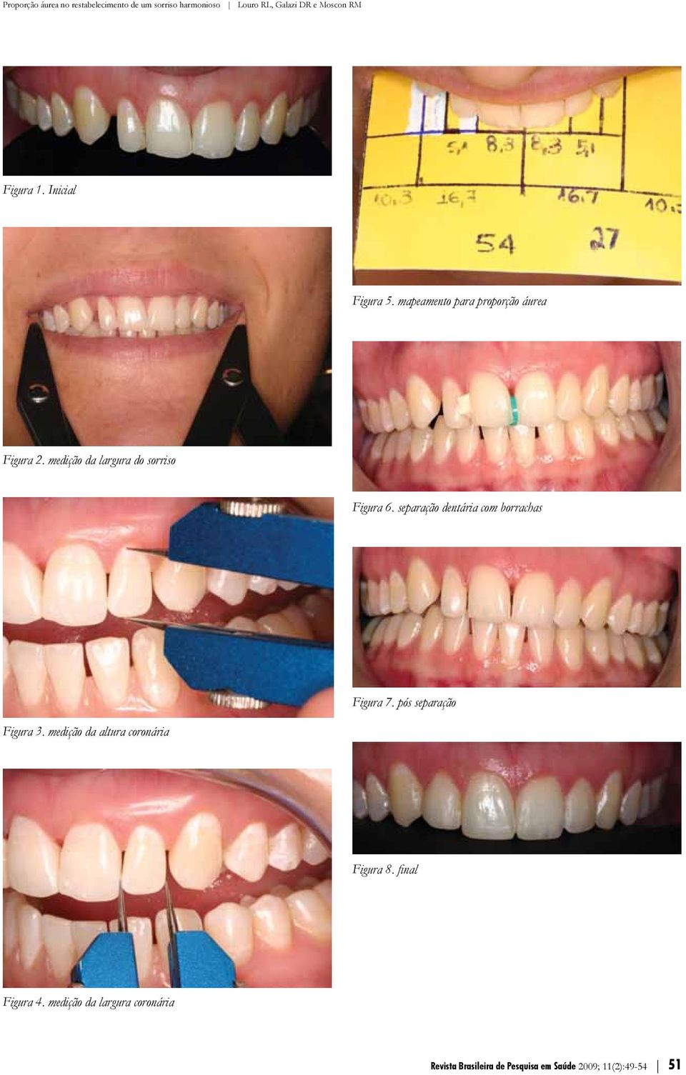 separação dentária com borrachas Figura 3. medição da altura coronária Figura 7.