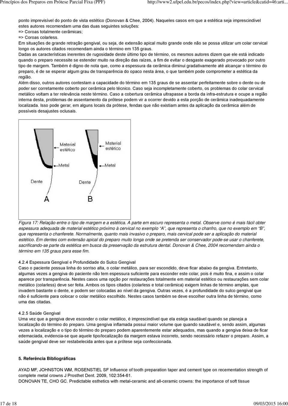 Em situações de grande retração gengival, ou seja, de extensão apical muito grande onde não se possa utilizar um colar cervical longo os autores citados recomendam ainda o término em 135 graus.