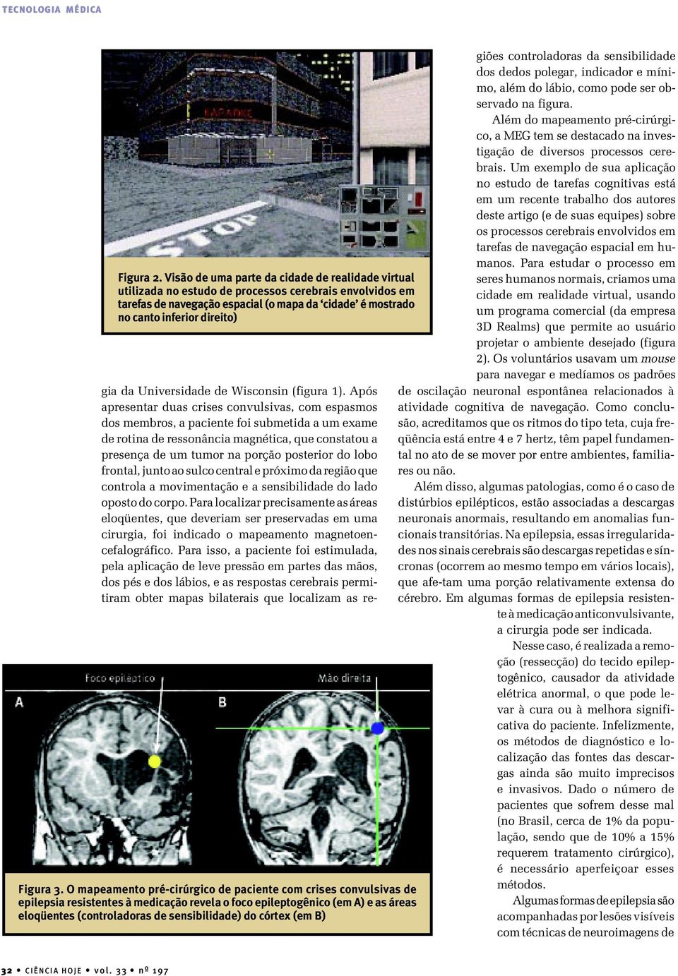 3. O mapeamento pré-cirúrgico de paciente com crises convulsivas de epilepsia resistentes à medicação revela o foco epileptogênico (em A) e as áreas eloqüentes (controladoras de sensibilidade) do