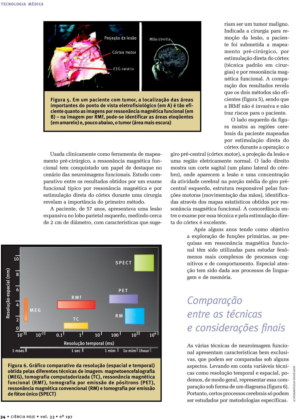 RMf, pode-se identificar as áreas eloqüentes (em amarelo) e, pouco abaixo, o tumor (área mais escura) Usada clinicamente como ferramenta de mapeamento pré-cirúrgico, a ressonância magnética funcional