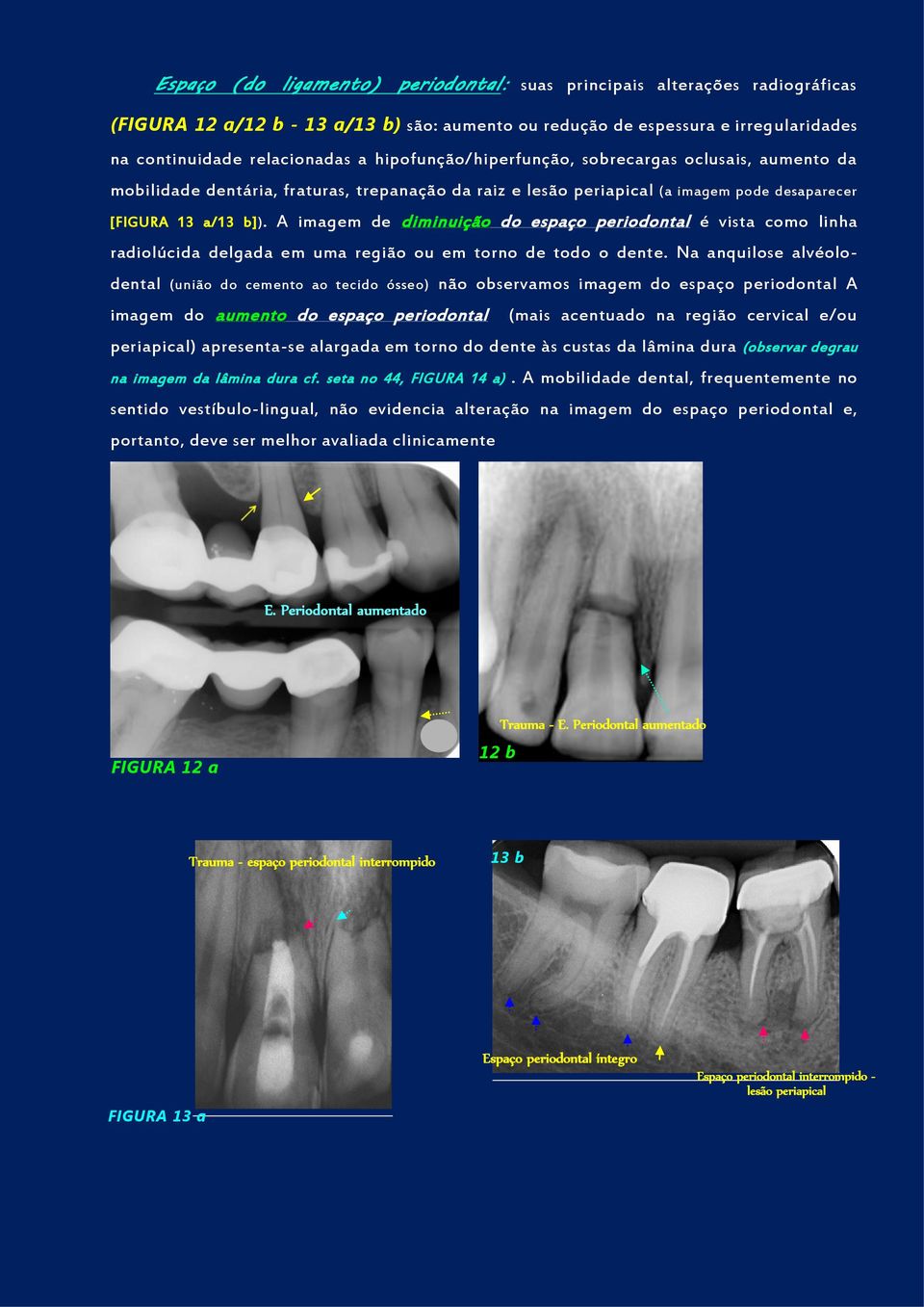 A imagem de diminuição do espaço periodontal é vista como linha radiolúcida delgada em uma região ou em torno de todo o dente.
