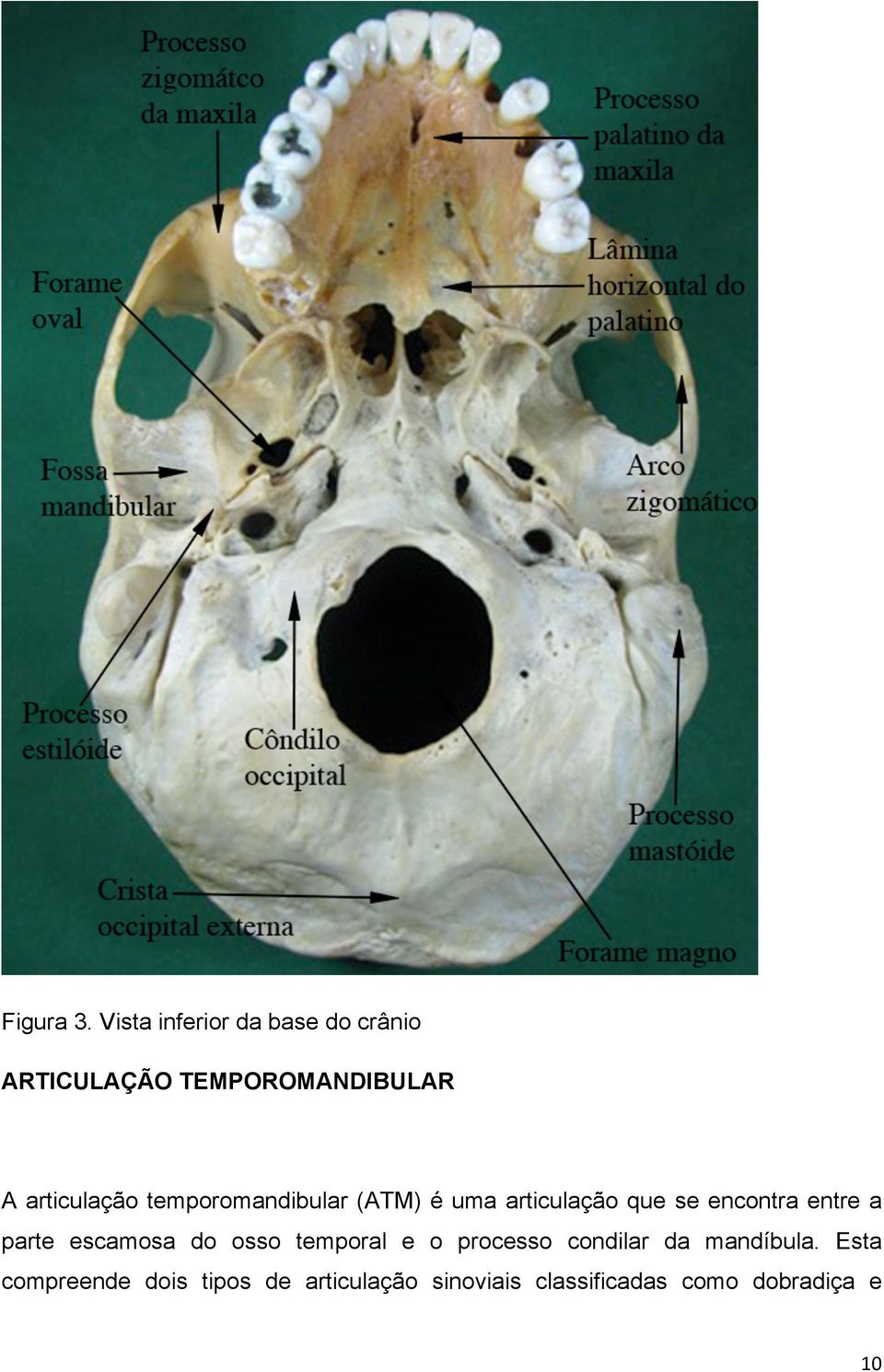 temporomandibular (ATM) é uma articulação que se encontra entre a parte
