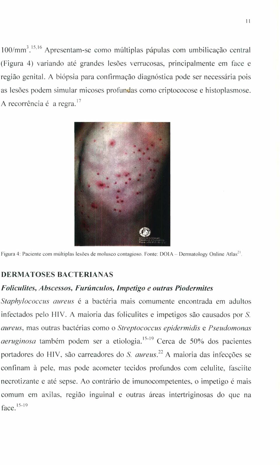 Õ Figura 4: Paciente com multiplas lesões de molusco contagioso. Fonte: DOIA ~ Dennatology Online Atlasn.