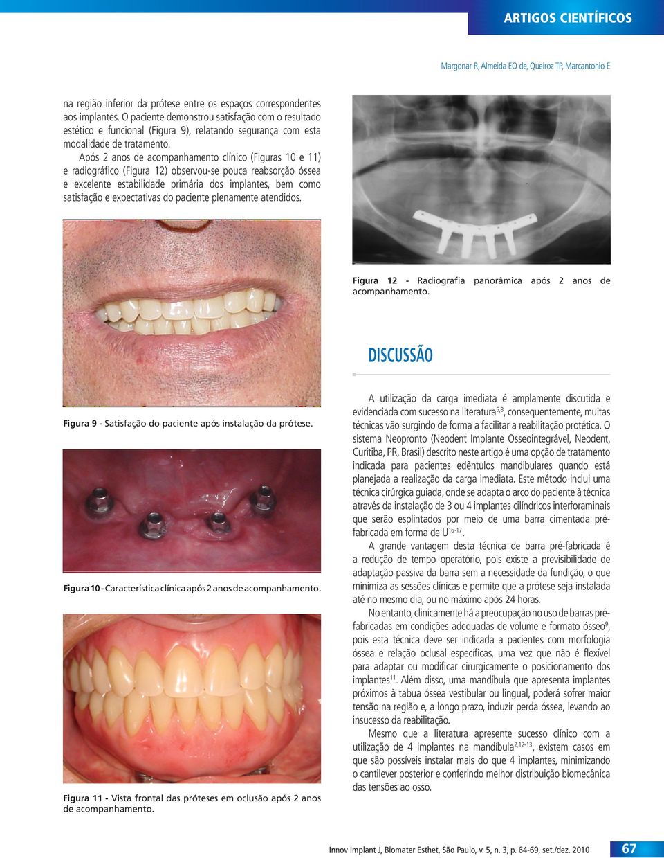 Após 2 anos de acompanhamento clínico (Figuras 10 e 11) e radiográfico (Figura 12) observou-se pouca reabsorção óssea e excelente estabilidade primária dos implantes, bem como satisfação e