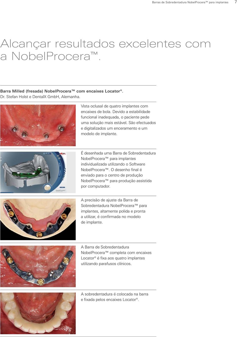 São efectuados e digitalizados um enceramento e um modelo de implante. É desenhada uma Barra de Sobredentadura NobelProcera para implantes individualizada utilizando o Software NobelProcera.