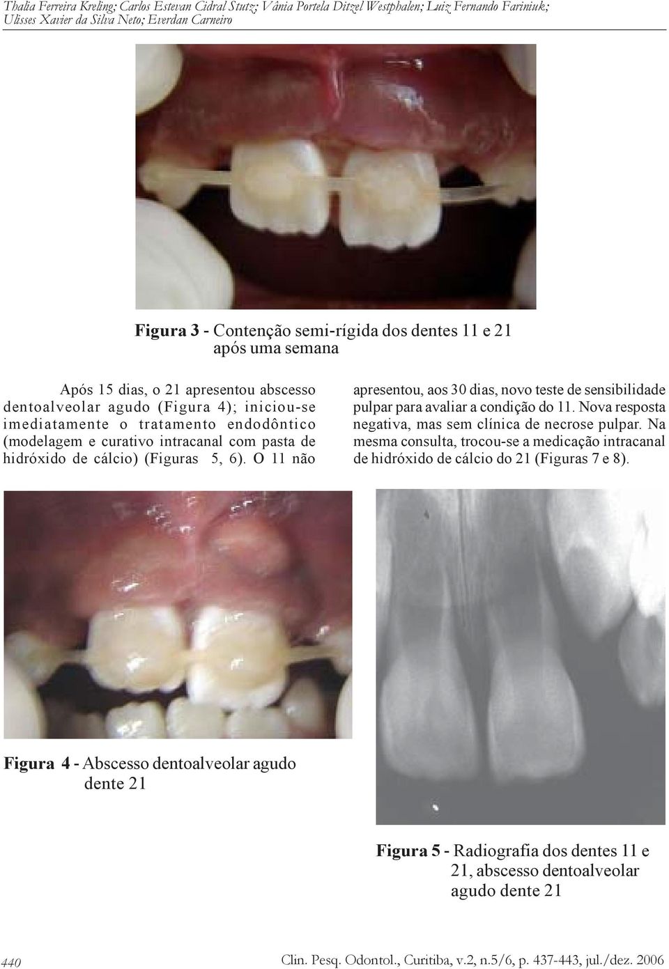 hidróxido de cálcio) (Figuras 5, 6). O 11 não apresentou, aos 30 dias, novo teste de sensibilidade pulpar para avaliar a condição do 11. Nova resposta negativa, mas sem clínica de necrose pulpar.