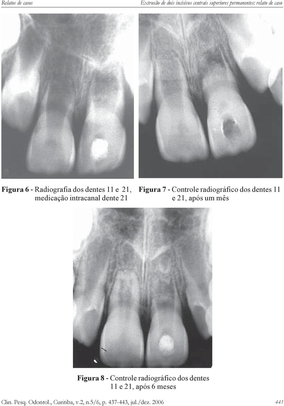 radiográfico dos dentes 11 e 21, após um mês Figura