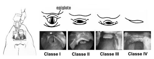 Índices de Cormack Grau I: Epiglote e cordas vocais bem visíveis Grau II: Somente a parte posterior da