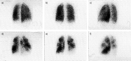 Tunariu N, J Nucl Med 2007 Cintilografia pulmonar de perfusão TEP crônico: falhas de enchimento segmentares, grandes e usualmente bilaterais, com a cintilografia de inalação normal Hipertensão