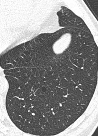 pneumonias intesticiais: Pneumonia intesticial bronquiolocêntrica