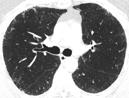Conceito O mesmo paciente pode ter vários tipos de Pneumonias intersticias (especialmente as tabaco-relacionadas).