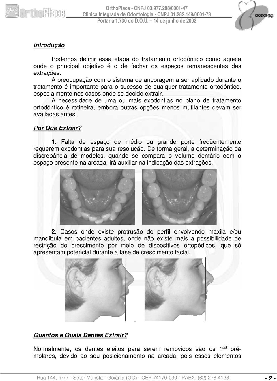 A necessidade de uma ou mais exodontias no plano de tratamento ortodôntico é rotineira, embora outras opções menos mutilantes devam ser avaliadas antes. Por Que Extrair? 1.