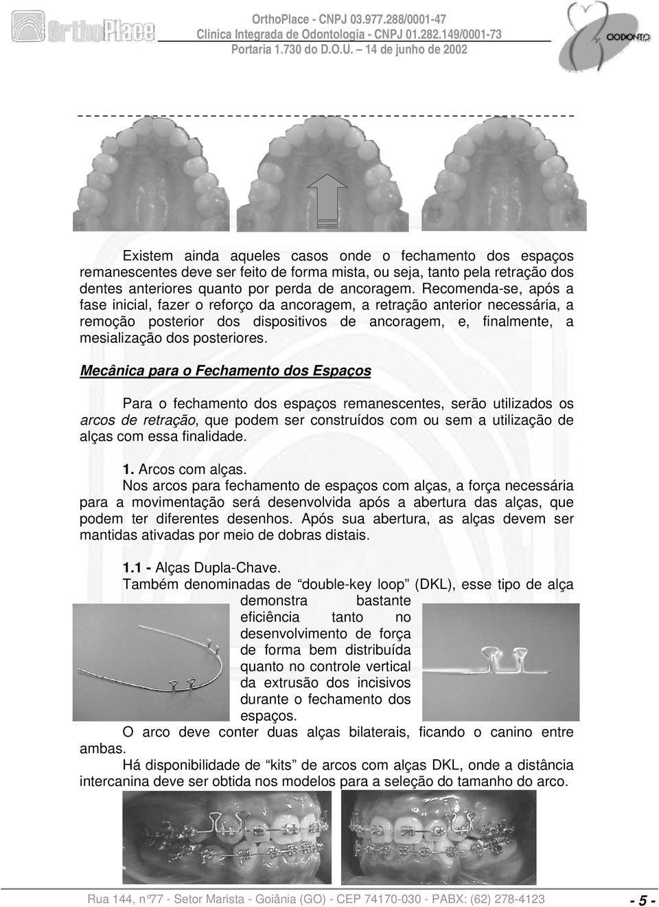 Mecânica para o Fechamento dos Espaços Para o fechamento dos espaços remanescentes, serão utilizados os arcos de retração, que podem ser construídos com ou sem a utilização de alças com essa