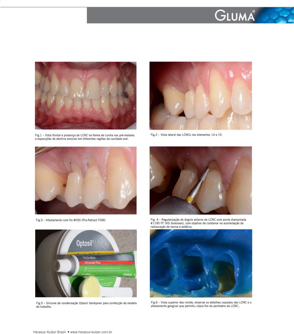 3 Afastamento com fio #000 (Pro-Retract FGM). Fig.