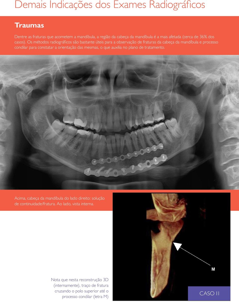 Os métodos radiográficos são bastante úteis para a observação de fraturas da cabeça da mandíbula e processo condilar para constatar a orientação das