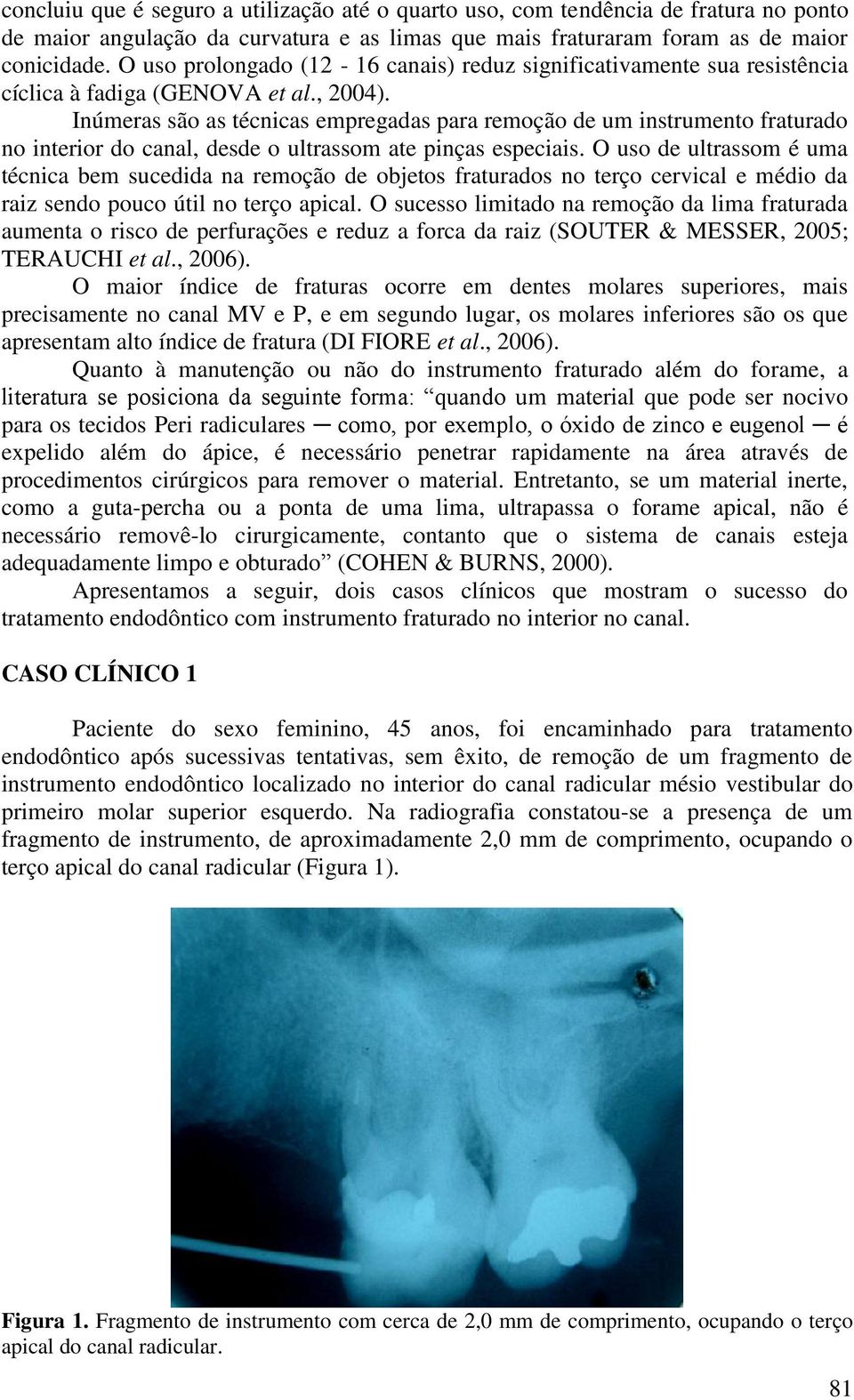 Inúmeras são as técnicas empregadas para remoção de um instrumento fraturado no interior do canal, desde o ultrassom ate pinças especiais.