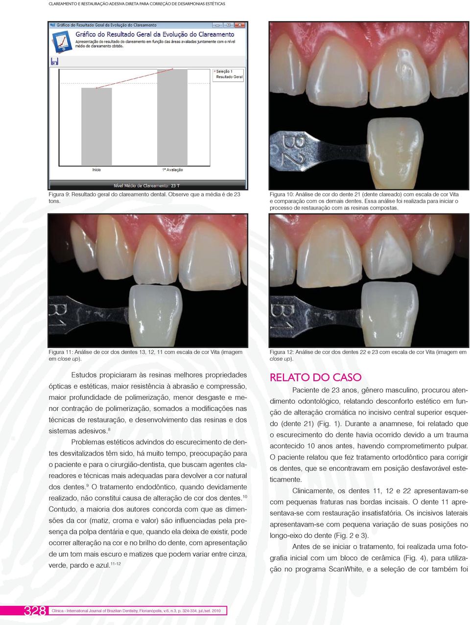 Essa análise foi realizada para iniciar o processo de restauração com as resinas compostas. Figura 11: Análise de cor dos dentes 13, 12, 11 com escala de cor Vita (imagem em close up).
