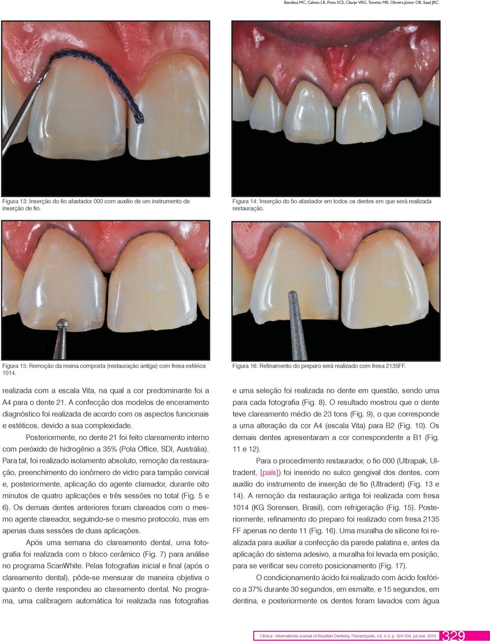 realizada com a escala Vita, na qual a cor predominante foi a A4 para o dente 21.