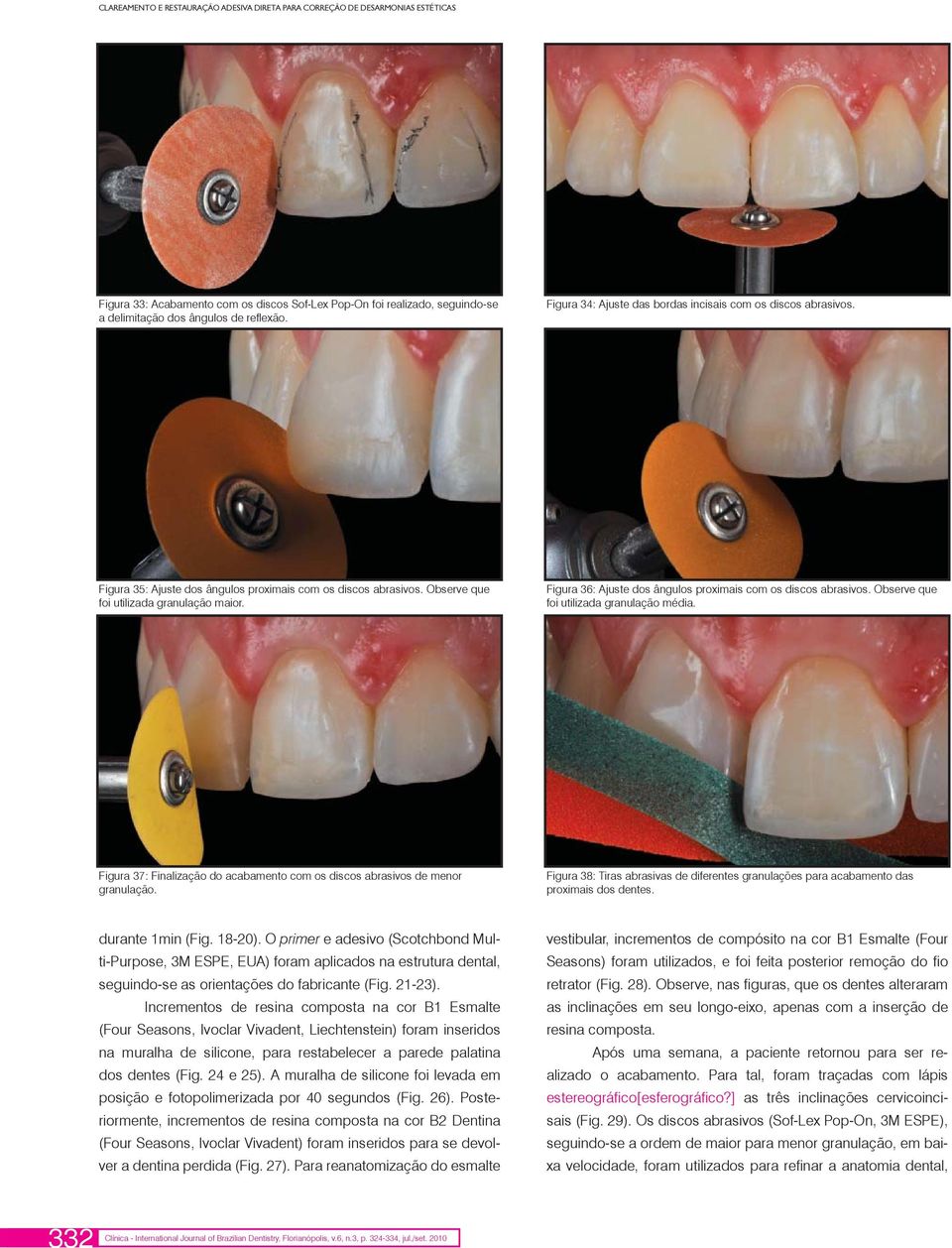 Figura 36: Ajuste dos ângulos proximais com os discos abrasivos. Observe que foi utilizada granulação média. Figura 37: Finalização do acabamento com os discos abrasivos de menor granulação.