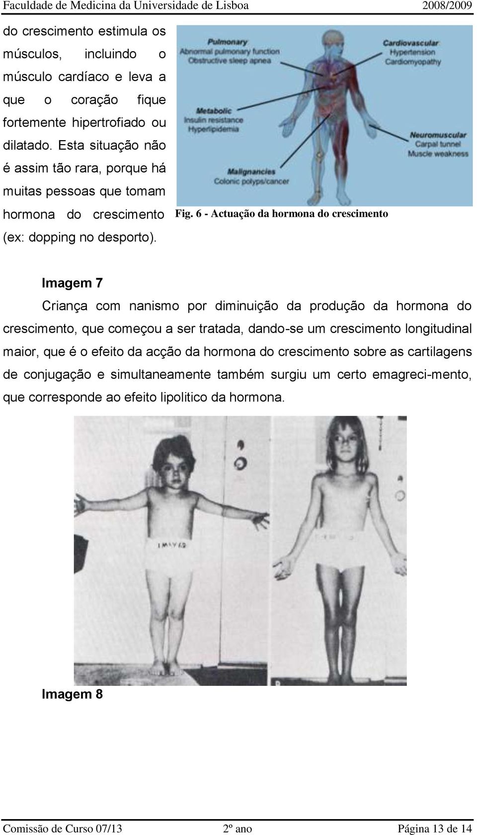 6 - Actuação da hormona do crescimento Imagem 7 Criança com nanismo por diminuição da produção da hormona do crescimento, que começou a ser tratada, dando-se um crescimento