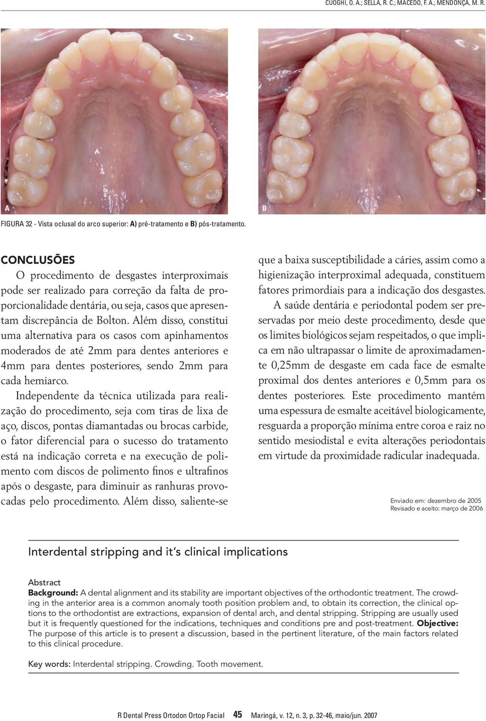 Além disso, constitui uma alternativa para os casos com apinhamentos moderados de até 2mm para dentes anteriores e 4mm para dentes posteriores, sendo 2mm para cada hemiarco.