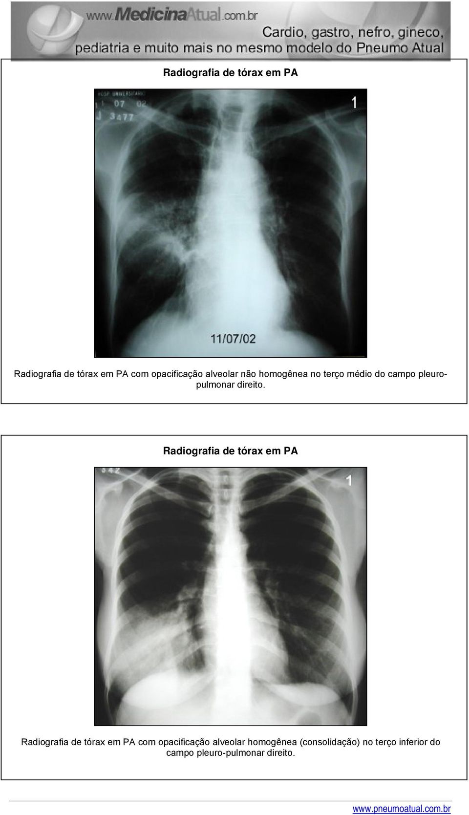 alveolar homogênea (consolidação) no terço inferior do campo