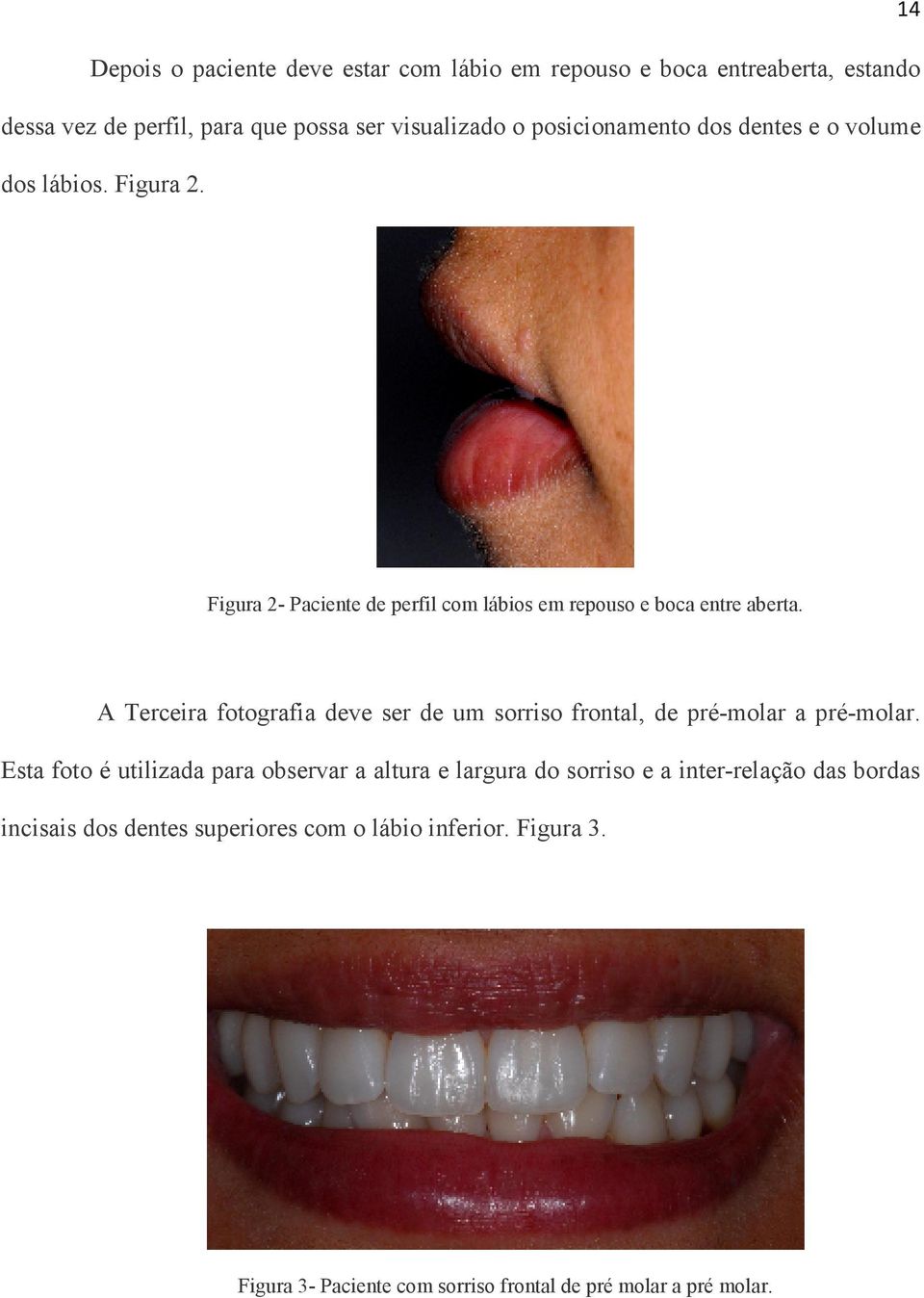 A Terceira fotografia deve ser de um sorriso frontal, de pré-molar a pré-molar.