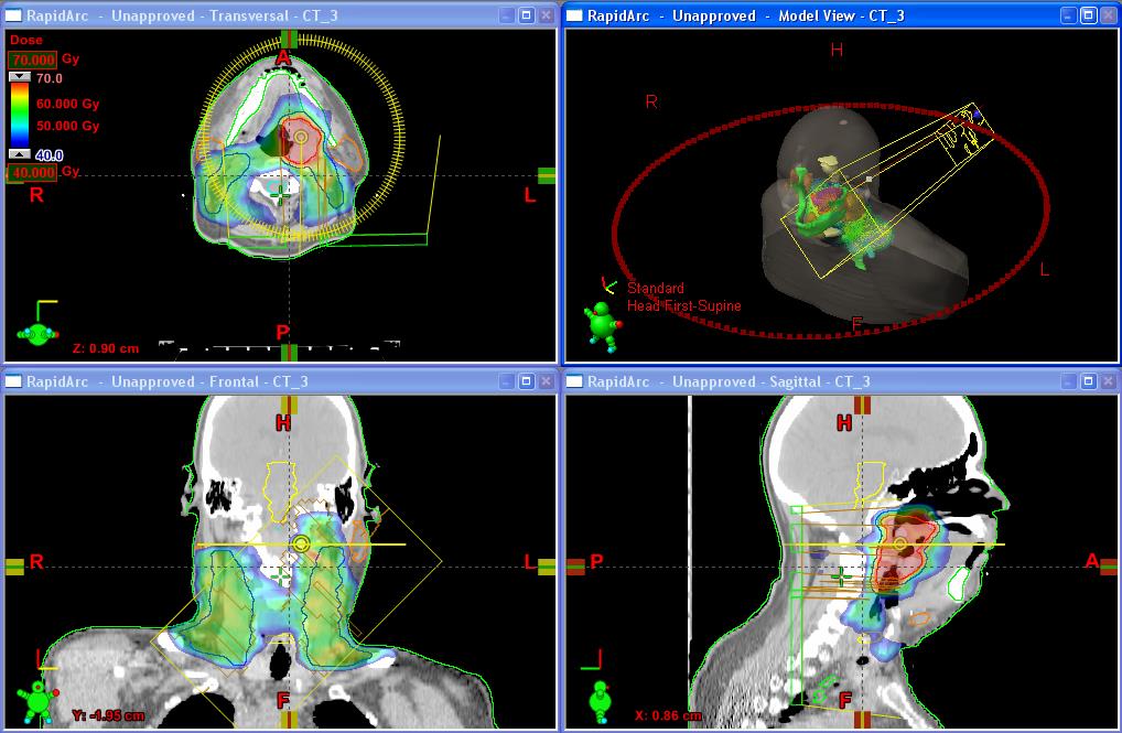 Modalidades de tratamento de teleterapia: Convencional (2D) Conformacional (3D)