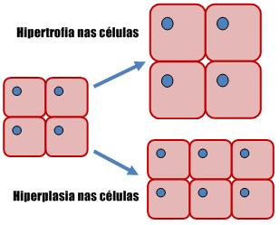 HIPERTROFIA X HIPERPLASIA Na hipertrofia, não se desenvolvem células novas, mas as já existentes aumentam de tamanho.