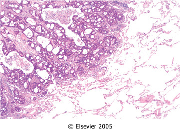 Metastização Metastização Disseminação vascular e homing Em circulação, as células