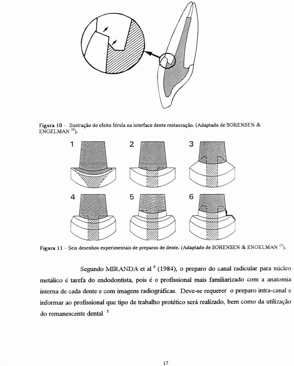 Segundo MIRANDA et al 6 (1984), o preparo do canal radicular para núcleo metálico é tarefa do endodontista, pois é o profissional mais