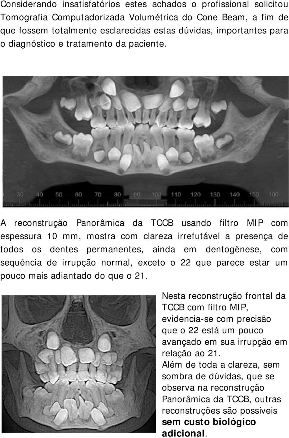 A reconstrução Panorâmica da TCCB usando filtro MIP com espessura 10 mm, mostra com clareza irrefutável a presença de todos os dentes permanentes, ainda em dentogênese, com sequência de irrupção
