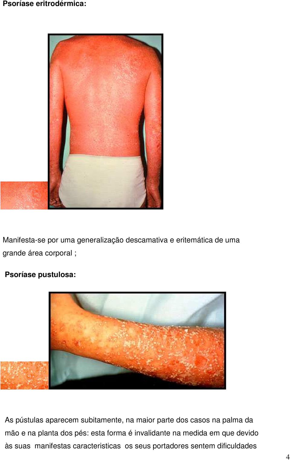 maior parte dos casos na palma da mão e na planta dos pés: esta forma é invalidante na