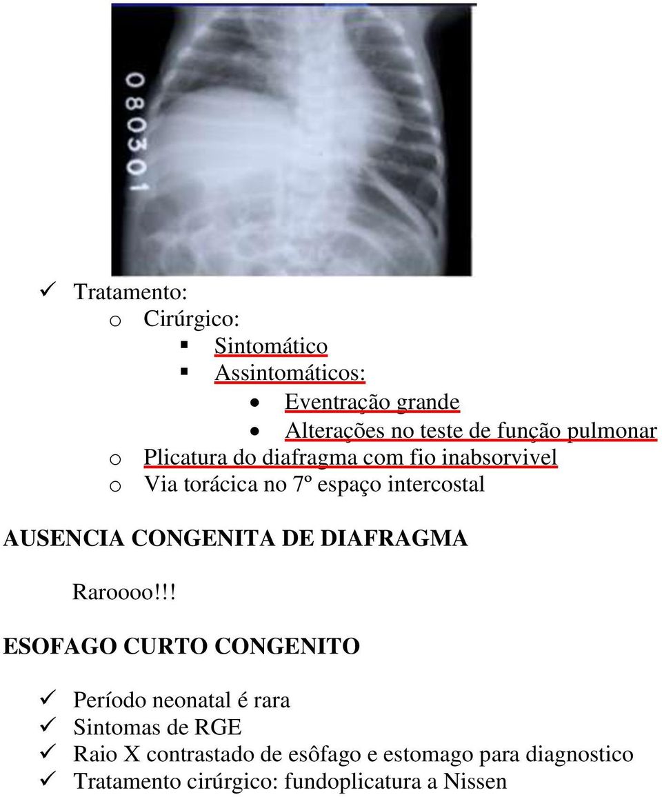 AUSENCIA CONGENITA DE DIAFRAGMA Raroooo!