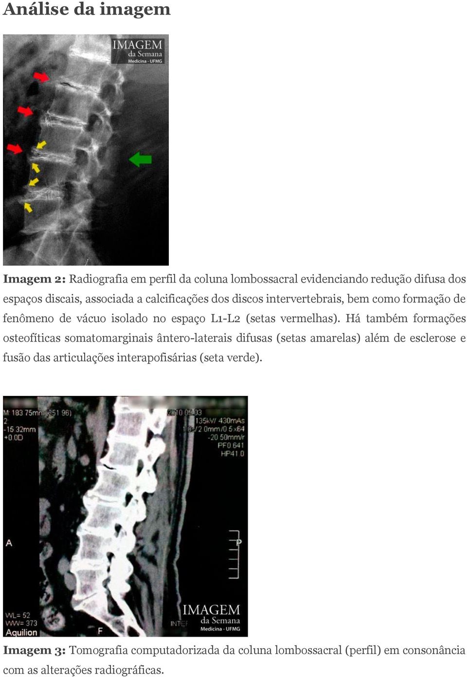 Há também formações osteofíticas somatomarginais ântero-laterais difusas (setas amarelas) além de esclerose e fusão das articulações